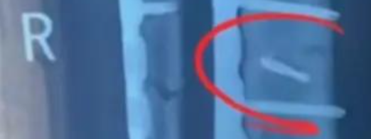 手术刀下的“遗忘”：同一病房两患者体内惊现钻头，医院竟隐瞒数月！